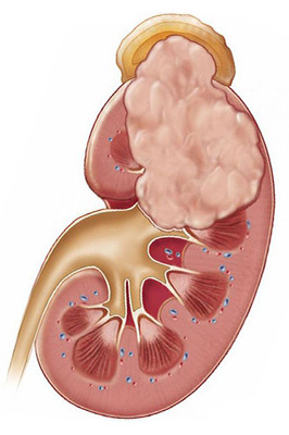 Лечение рака почек в клинике Медис