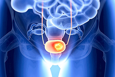 Лечение рака мочевого пузыря в клинике Медис