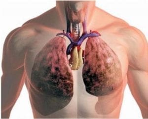 Третья стадия рака лёгких - применение дурвалумаба 1