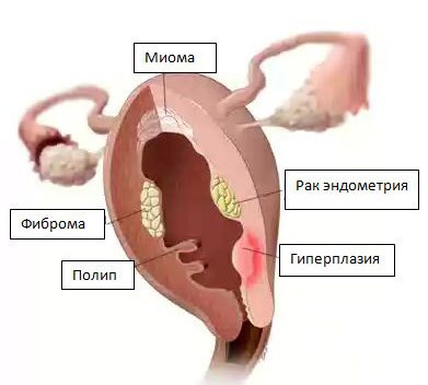Общая информация о раке матки 3
