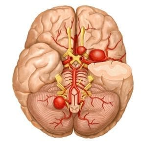 Что такое аневризма сосудов головного мозга? 1