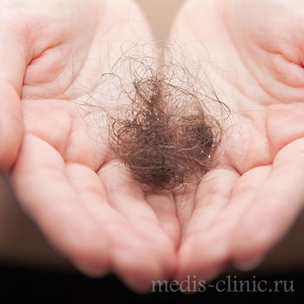 Выпадение волос химиотерапия