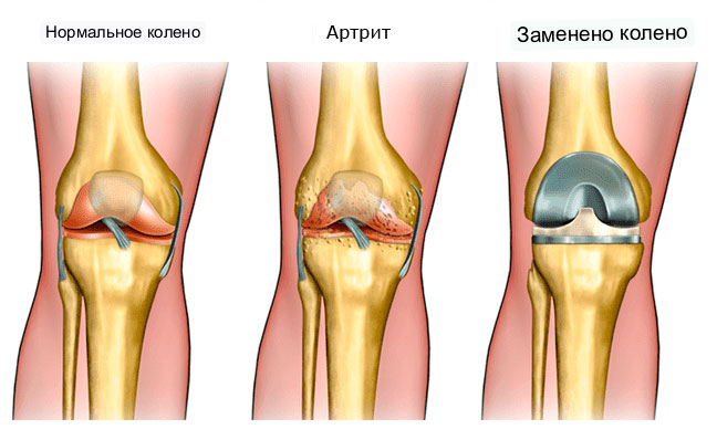 Замена коленного сустава