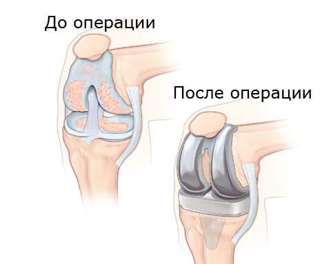Замена коленного сустава