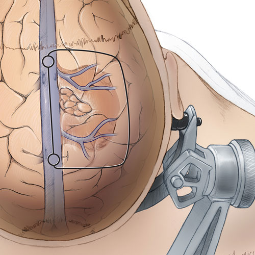 Краниотомия черепа операция