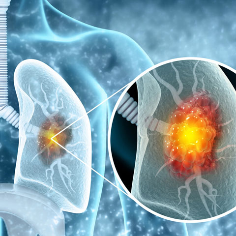 Скрининг онкология лёгких
