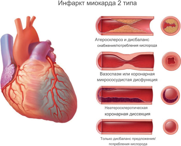 Инфаркт миокарда 2 типа