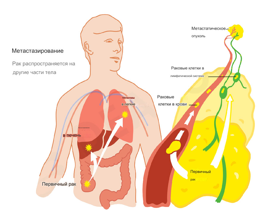 Метастазирование рак