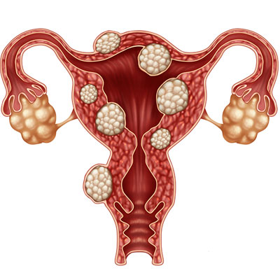 Миома матки диагноз