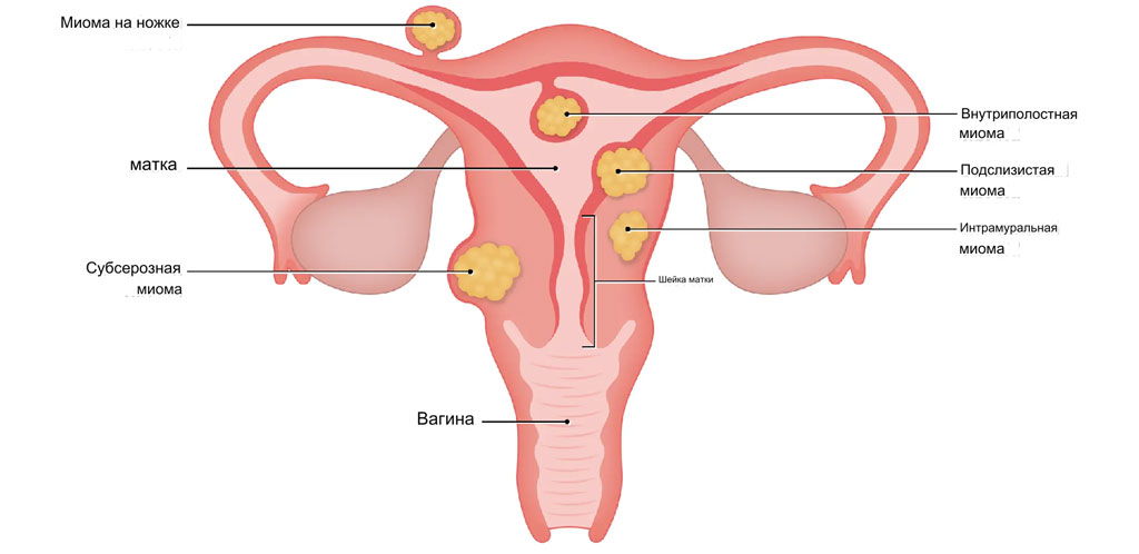 Миома матки схема