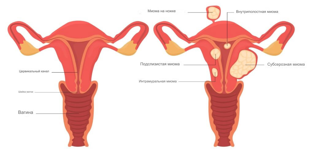 Миома матки схема