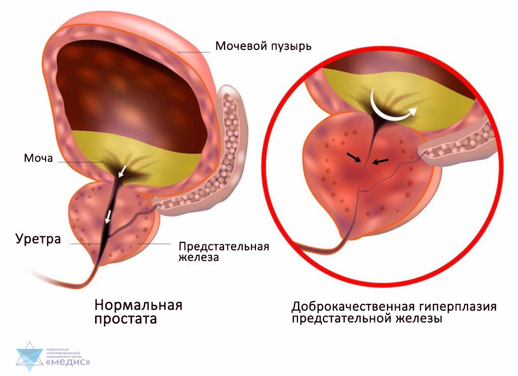 Аденома простаты