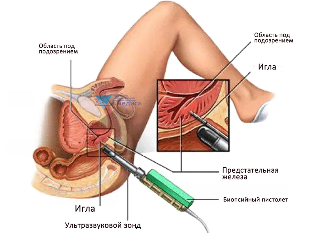 Биопсия простаты