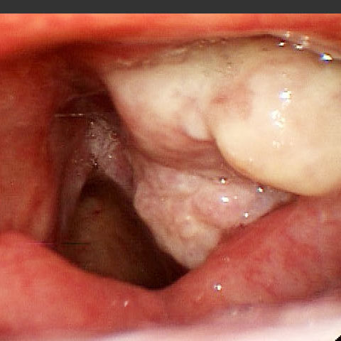 Гортань больного раком