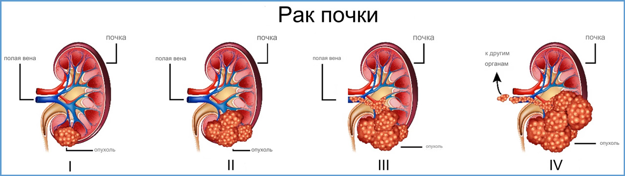 Почечно-клеточный рак стадии