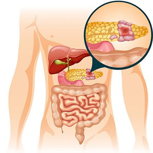 Рак поджелудочной вылечить