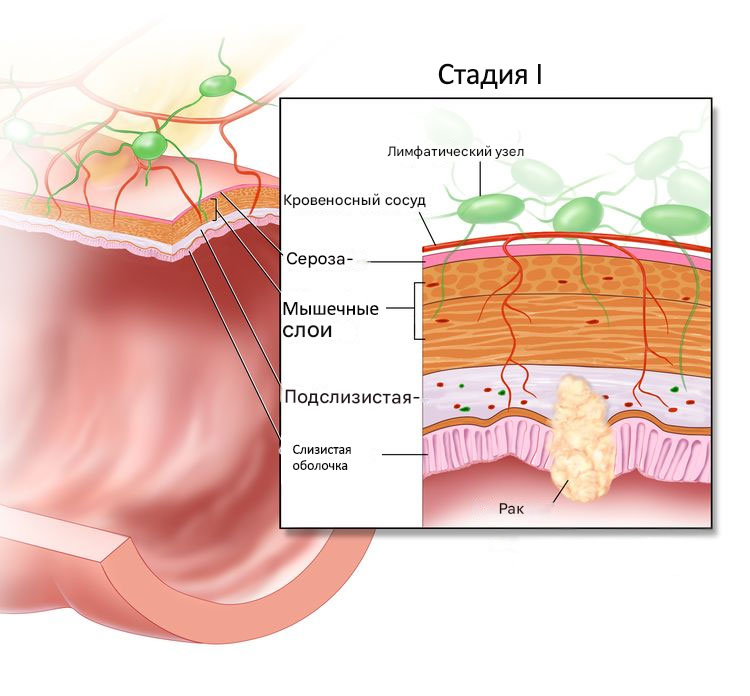 Первая стадия рака кишки