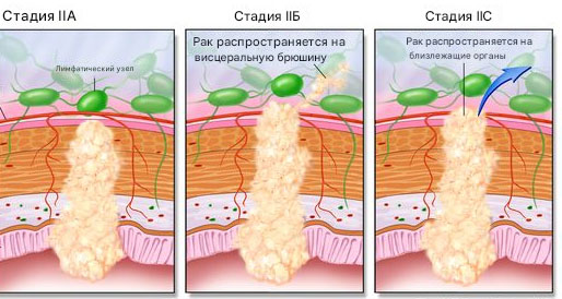 Вторая стадия рака