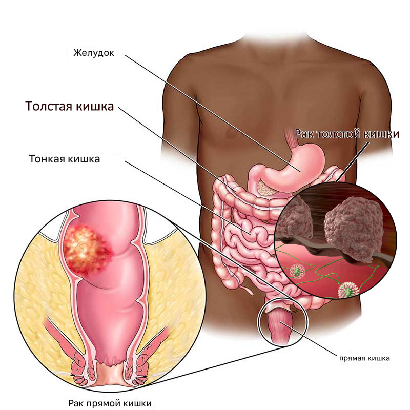 Рак прямой и толстой кишки