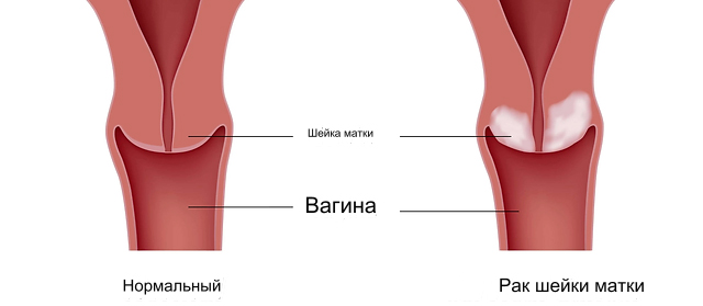 Рак шейки матки