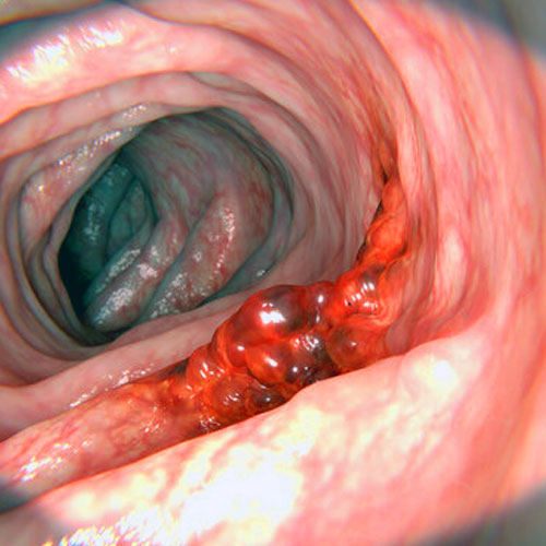 Рак толстой кишки. Эффективная помощь на любой стадии!