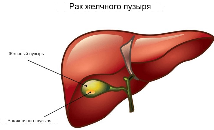 Рак желчного пузыря лечение