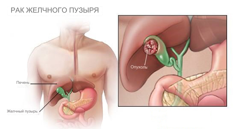 Рак желчного пузыря опухоль