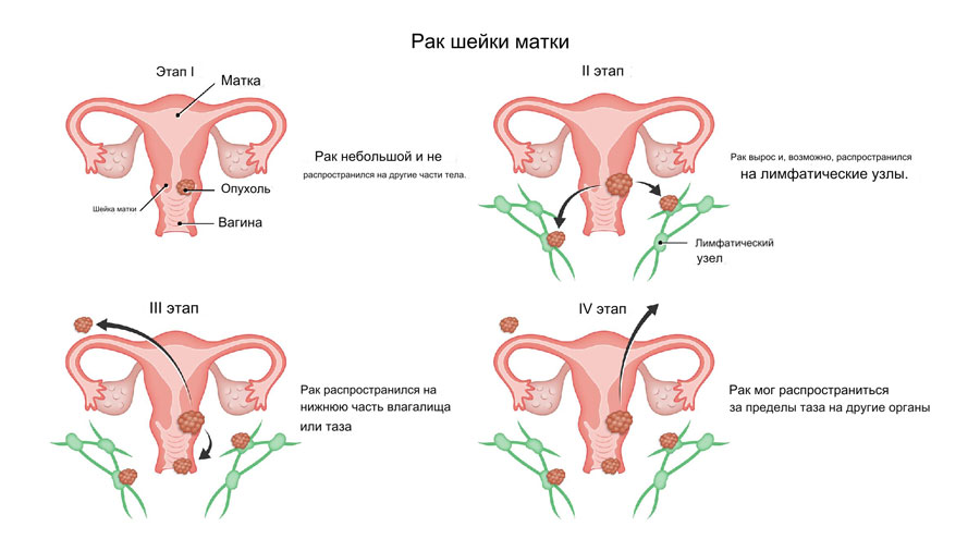 Стадии рак матки
