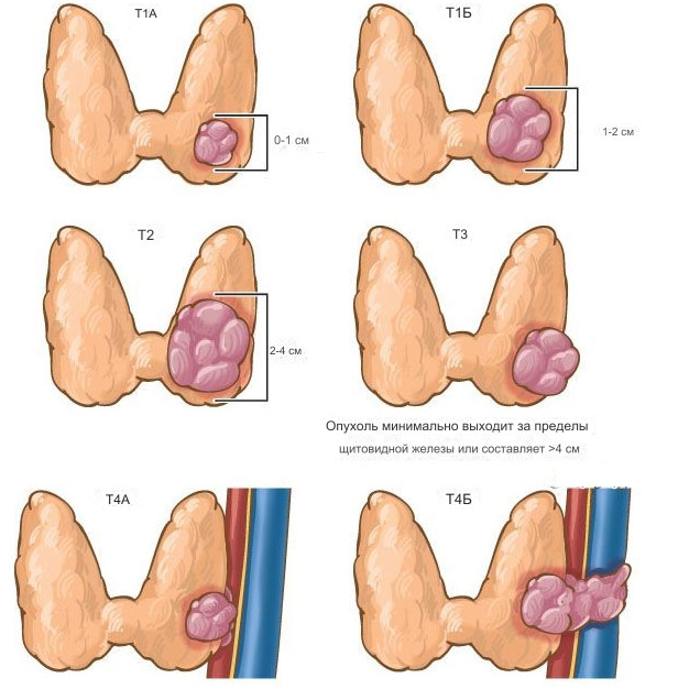 Стадии рака щитовидной железы