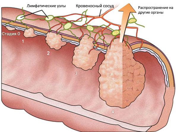 Стадии рака толстой кишки