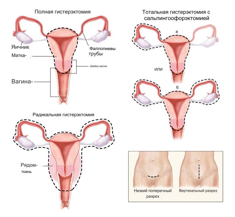 Виды операций рак матки