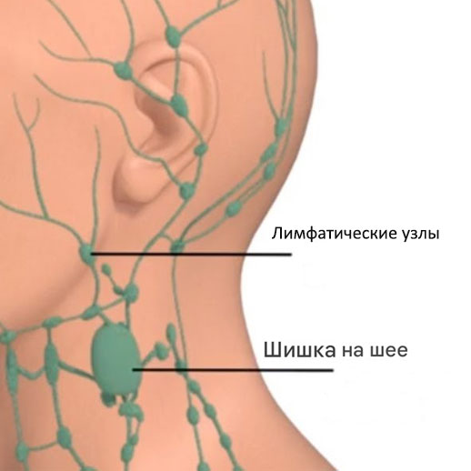 Метастазы плоскоклеточного рака