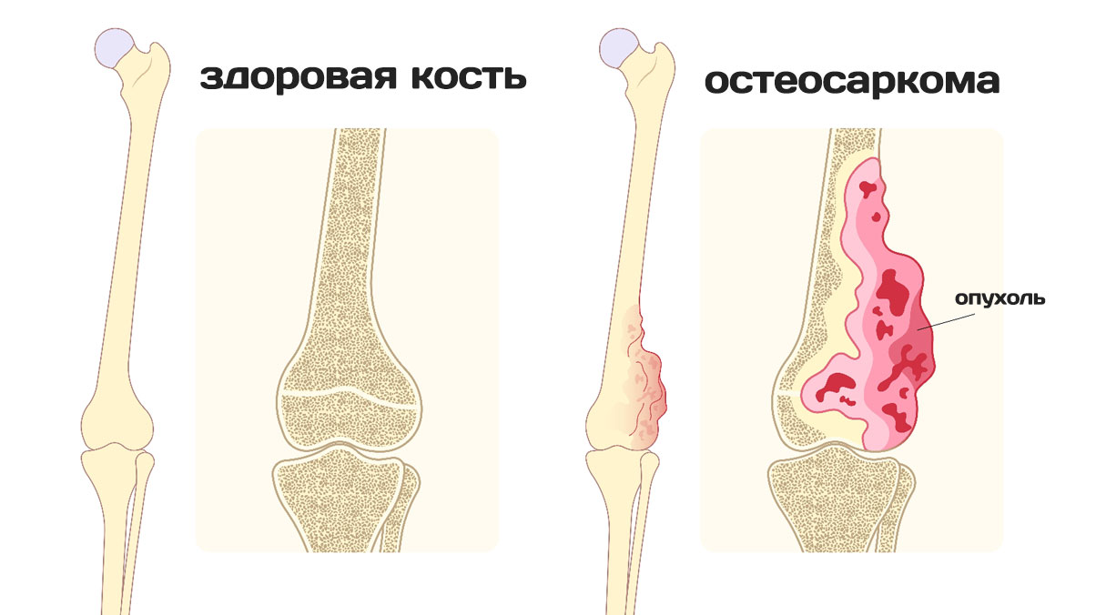 Остеосаркома рак костей