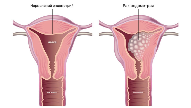 Рак эндометрия клиника