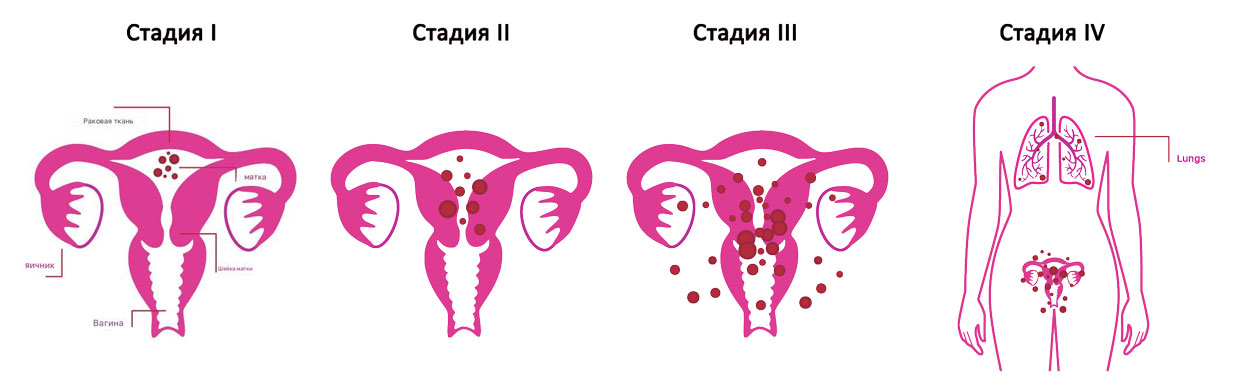 Рак эндометрия стадии