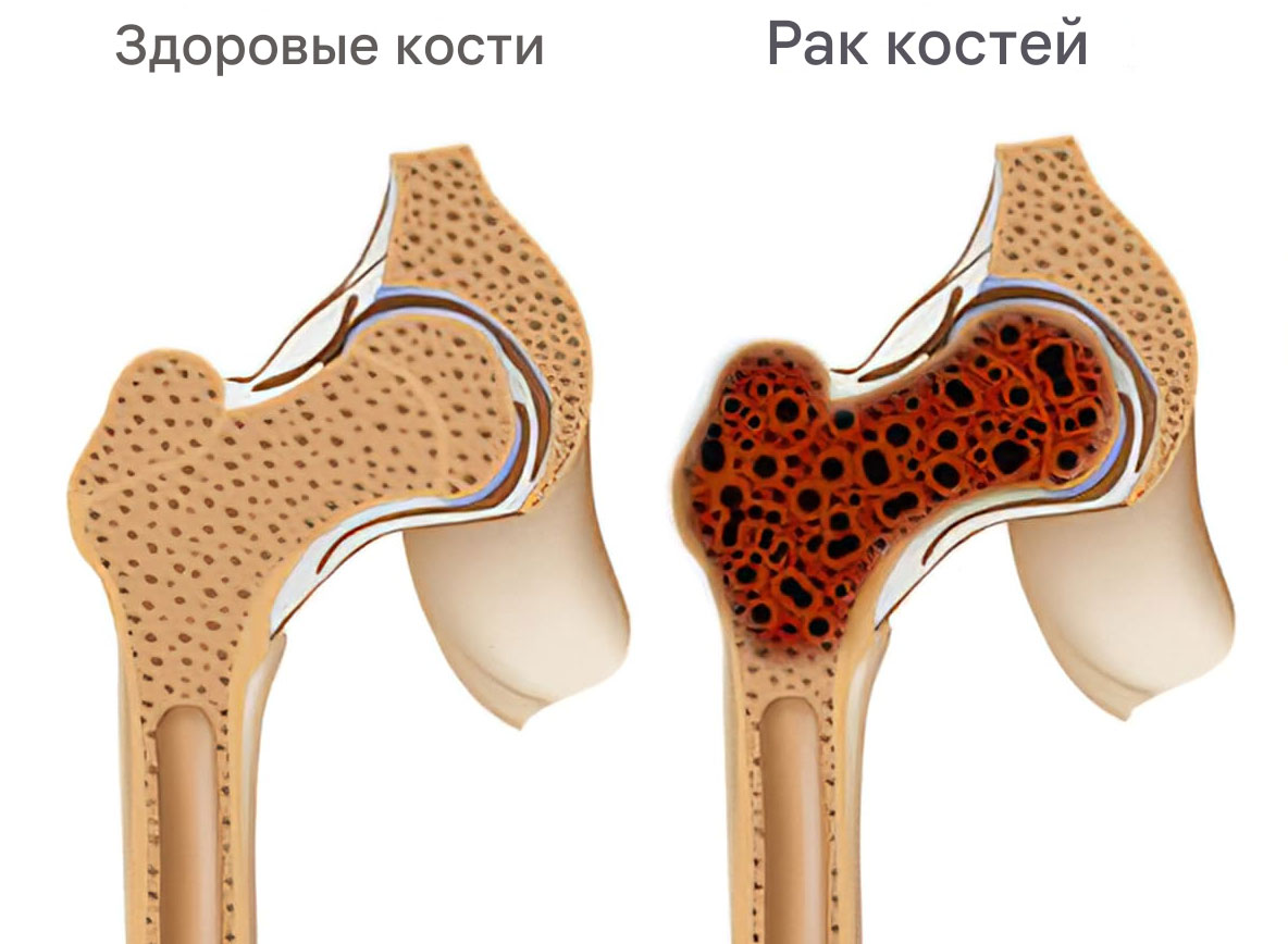 Рак костей Москва