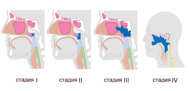 рак носоглотки стадии
