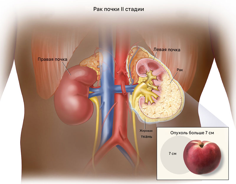 Рак почки 2 стадия