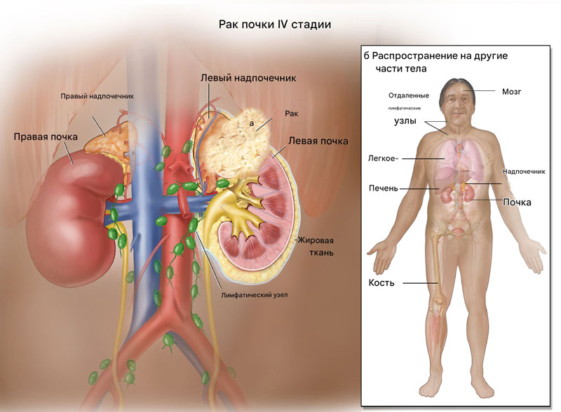 Рак почки 4 стадия