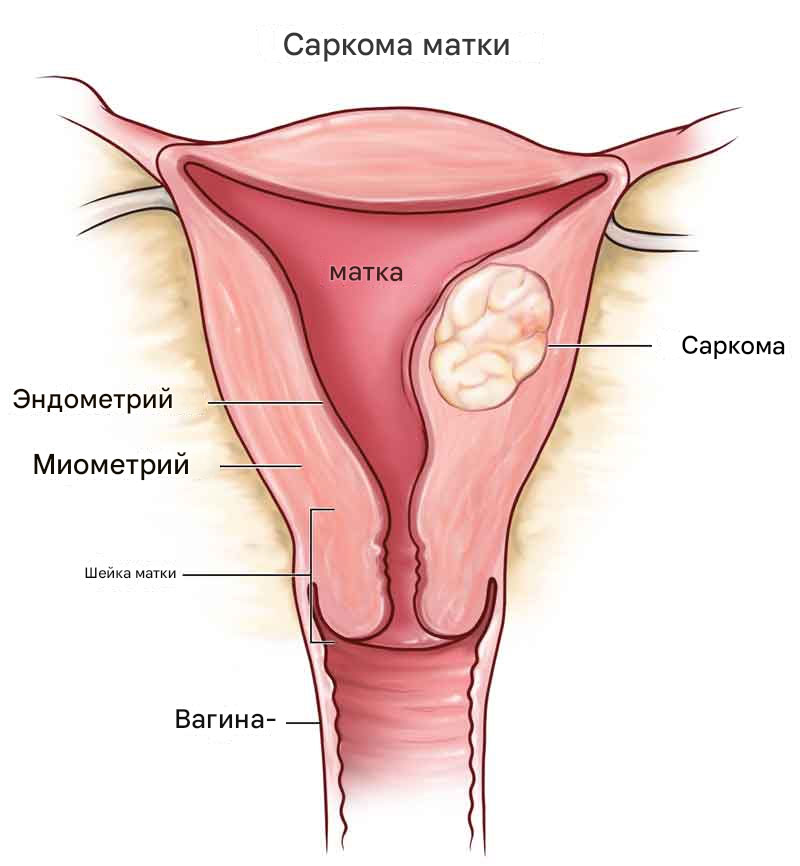 Саркома матки