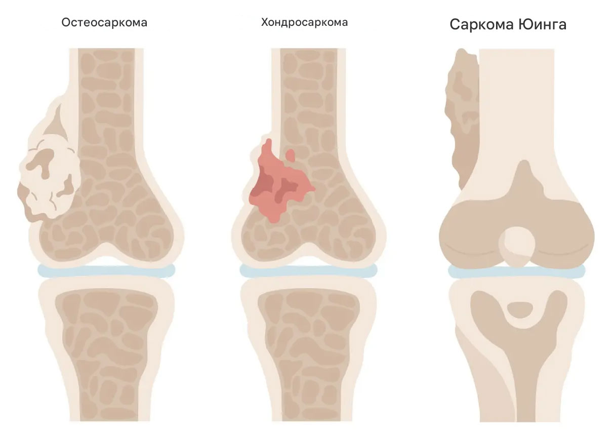 Саркома рак костей