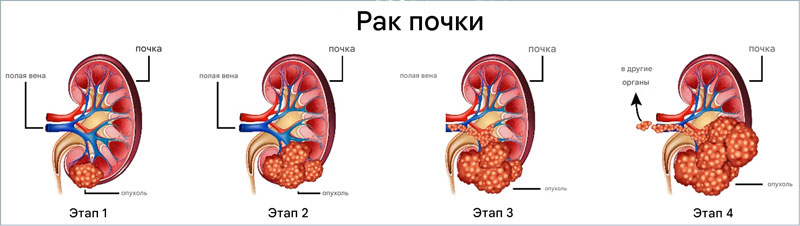 Стадии рака почки